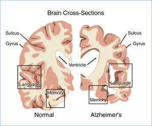 Comparing a Normal Brain and an Alzheimer's Brain
